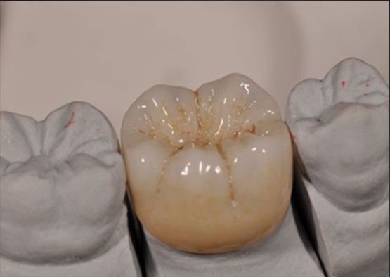 উচ্চ সৌন্দর্য Noritake Zirconia প্রাকৃতিক রঙ পূর্ণ Zirconia মুকুট জন্য স্থিতিশীল